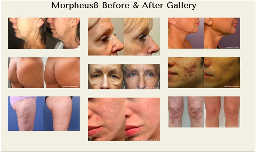 Morpheus8 Microneedling With Radiofrequency Results San Diego