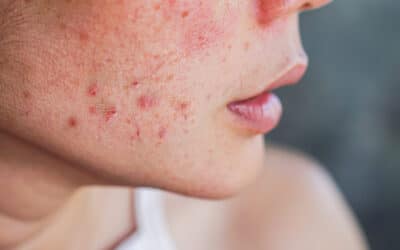 How Intense Pulsed Light Can Improve Your Complexion