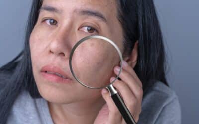 Morpheus8 for Large Pores: Can It Help Minimize Their Appearance?