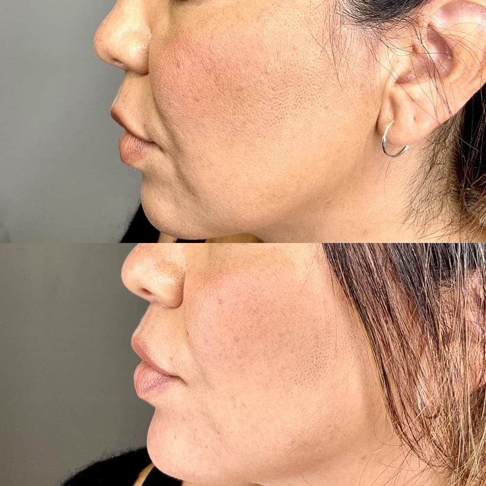 Jawline contouring before and after San Diego Jawline